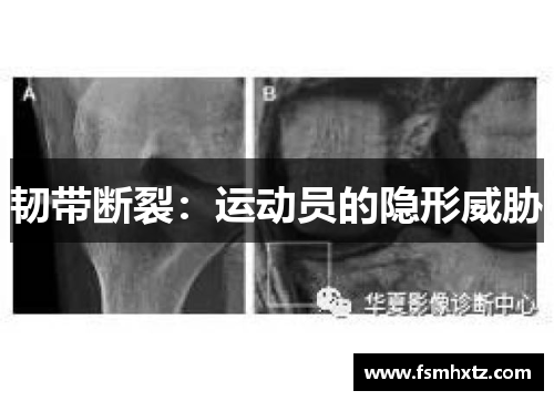 韧带断裂：运动员的隐形威胁
